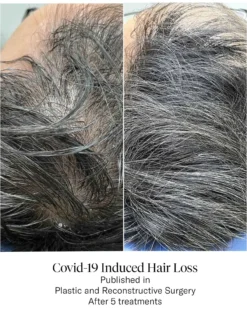 Advanced Hair System Kit Tratamiento de Regeneración Capilar