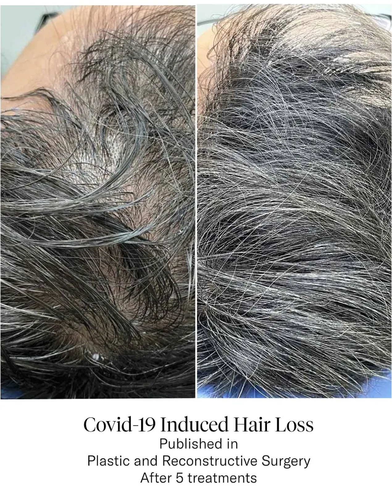 Advanced Hair System Kit Tratamiento de Regeneración Capilar