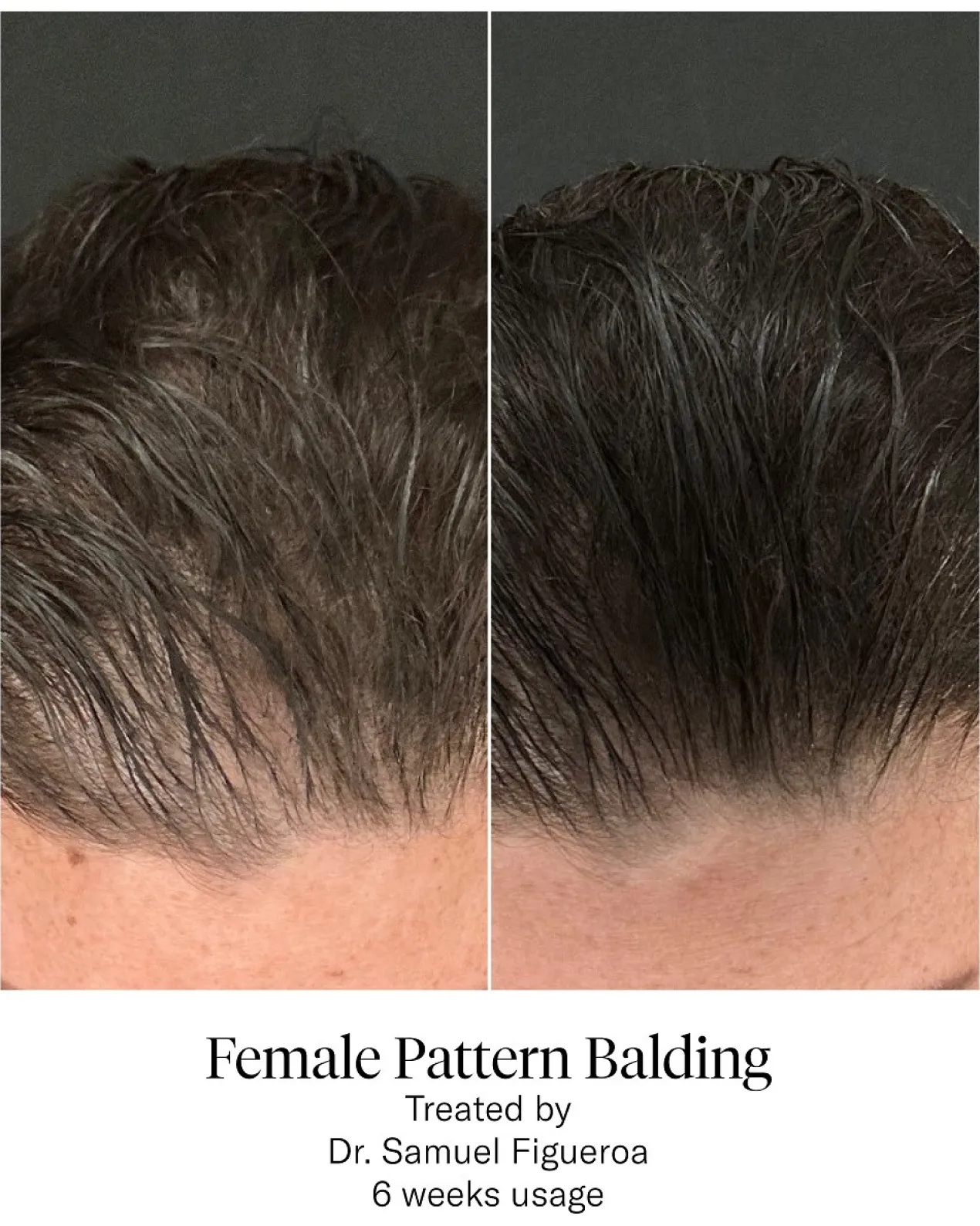 Advanced Hair System Kit Tratamiento de Regeneración Capilar