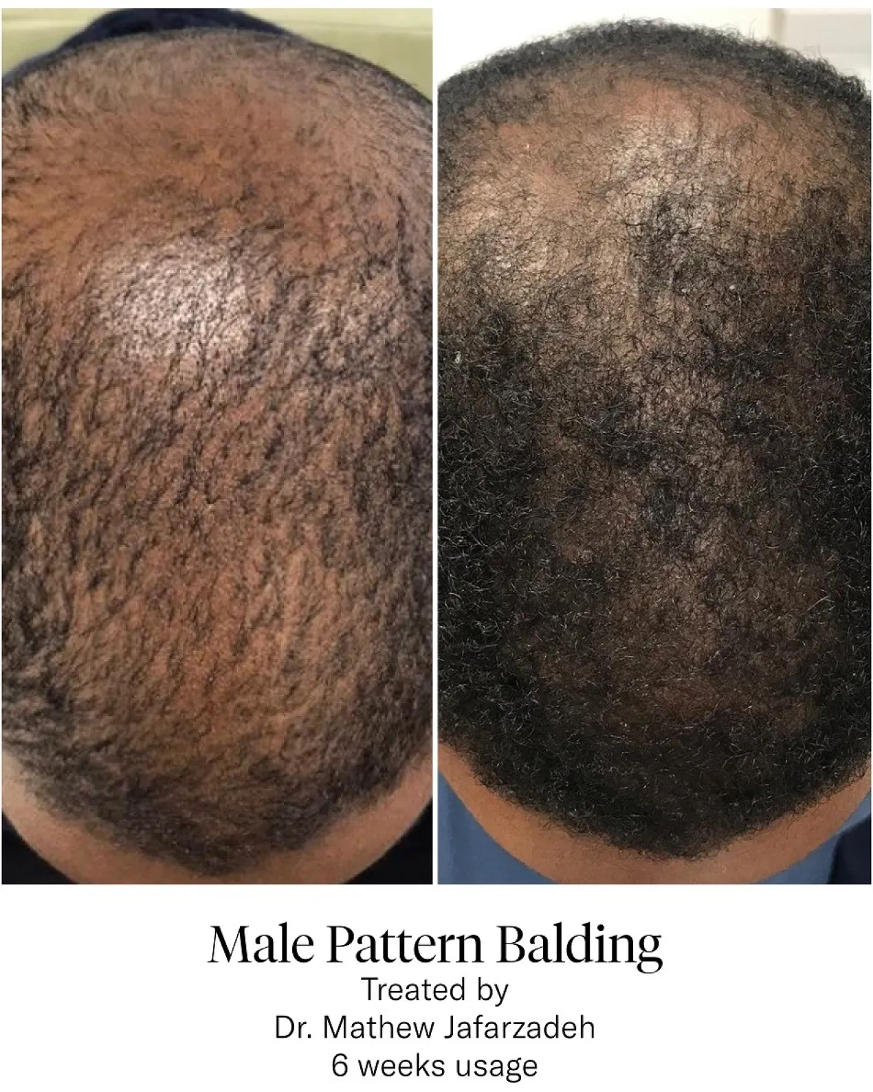 Advanced Hair System Kit Tratamiento de Regeneración Capilar