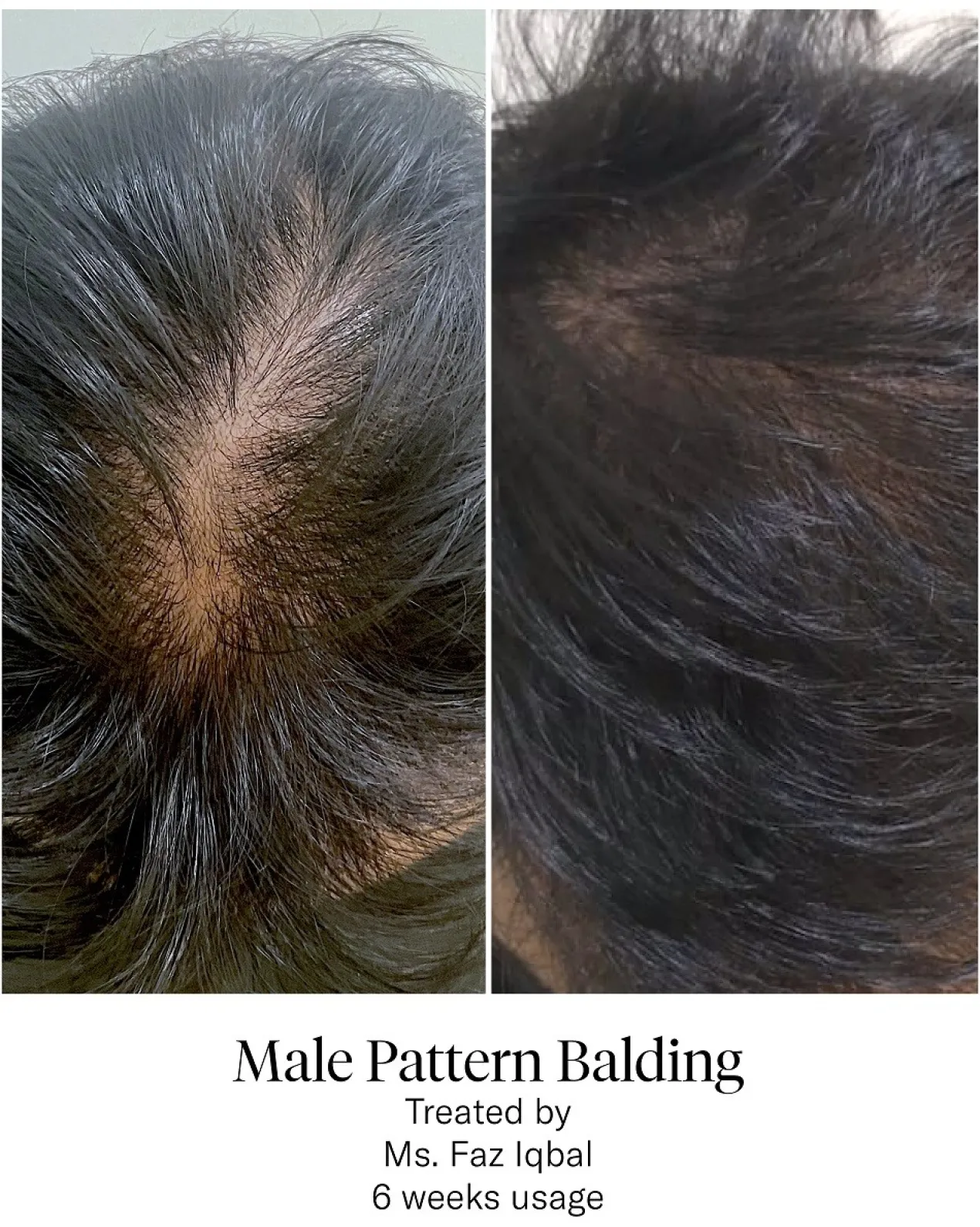 Advanced Hair System Kit Tratamiento de Regeneración Capilar