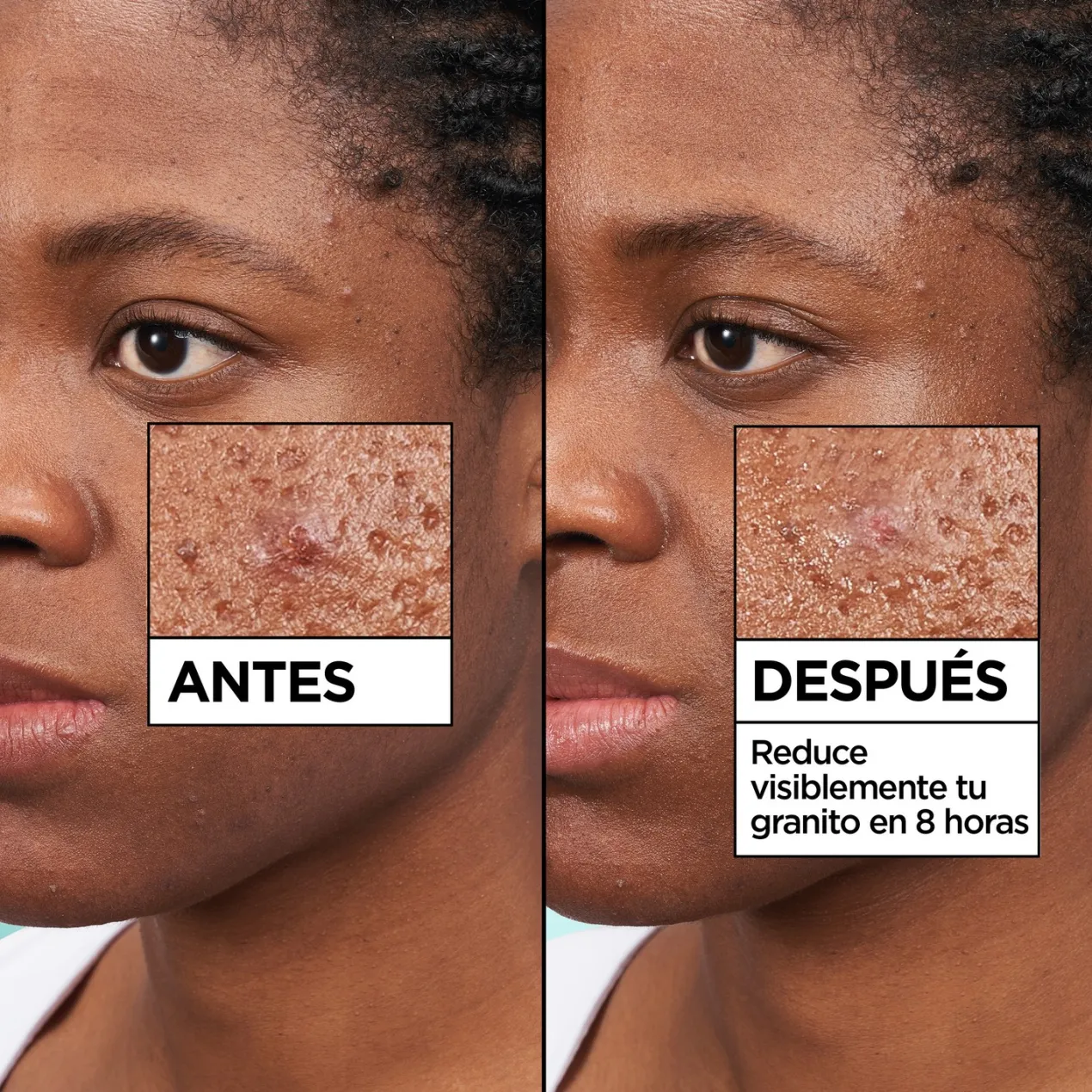 Pure Active Pimple Patch Invisible 8h Parche con Tecnología Hidrocoloide con BHA para Granitos